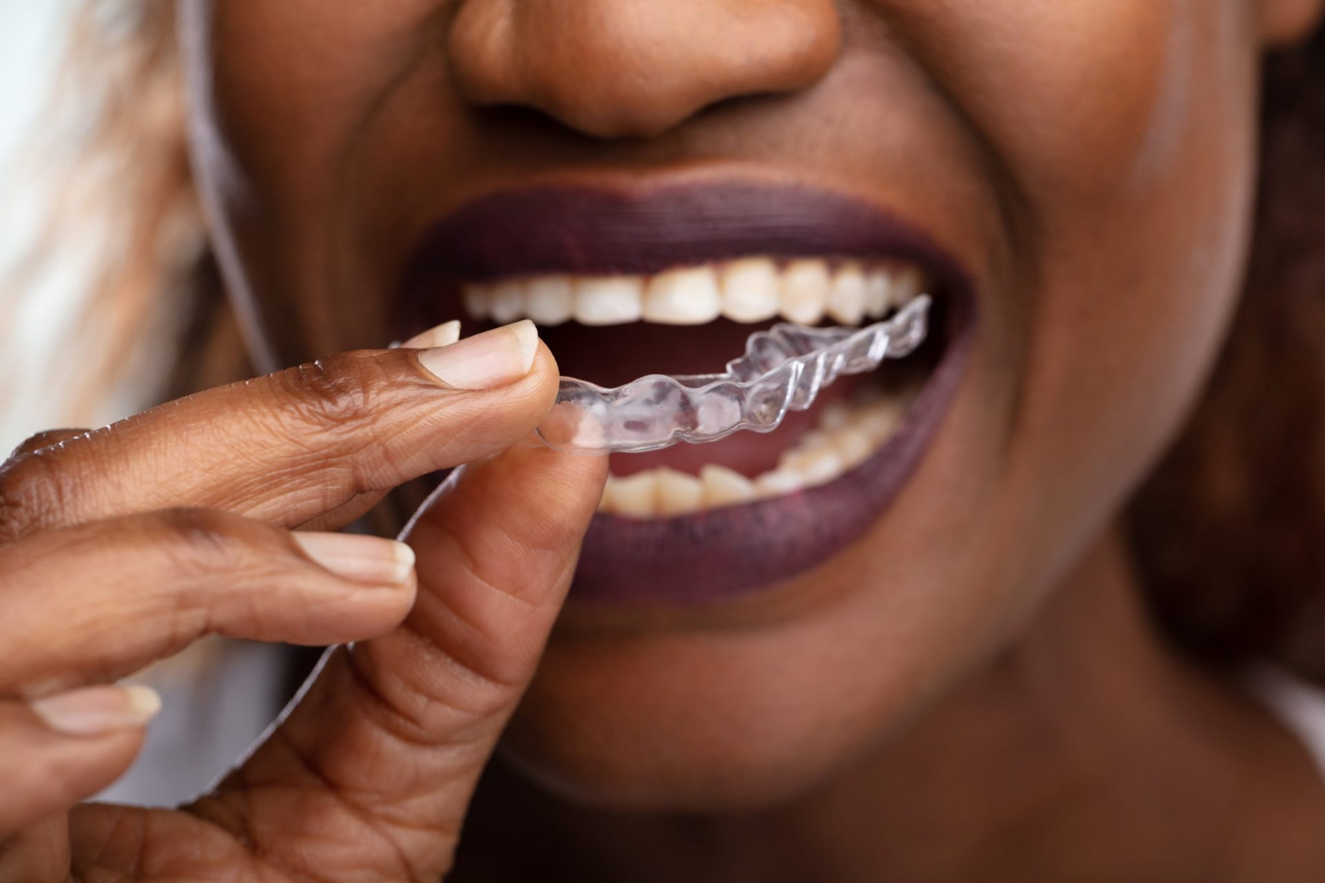 Teeth Grinding: The Signs and Symptoms of Bruxism for Adults