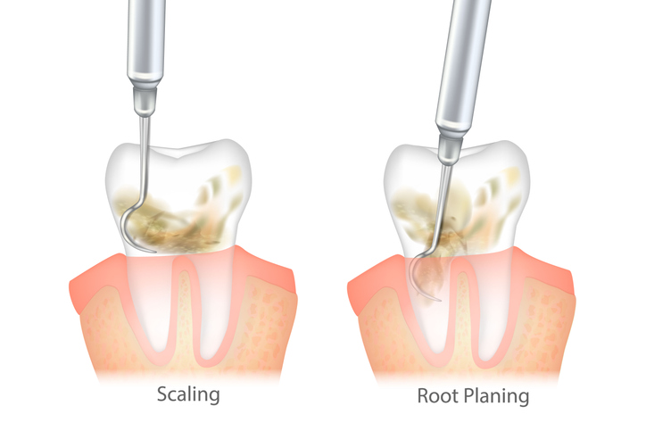 Scaling and root planing side by side