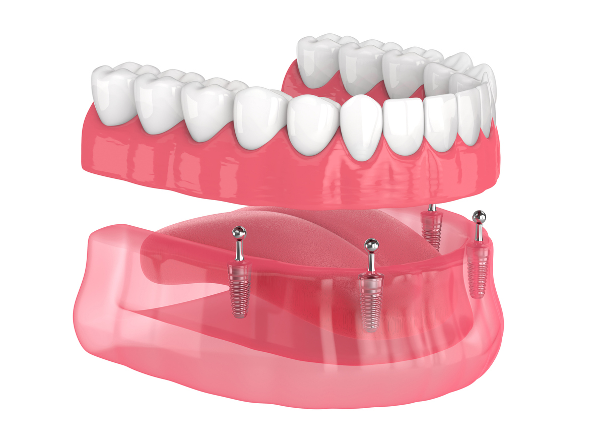 The Power of Implant-Supported Dentures in Phoenix | Arizona ...