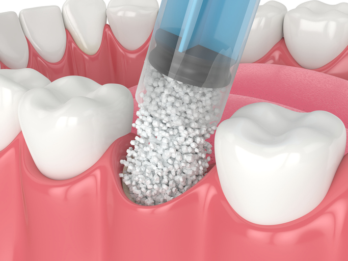 Bone graft using biomaterial.