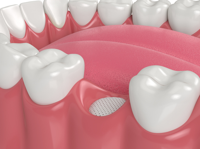 Bone graft using membrane