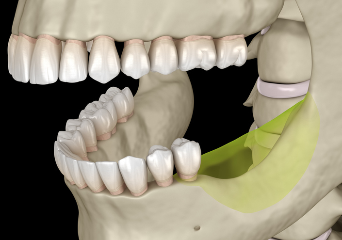 jaw bone recession after losing molars teeth