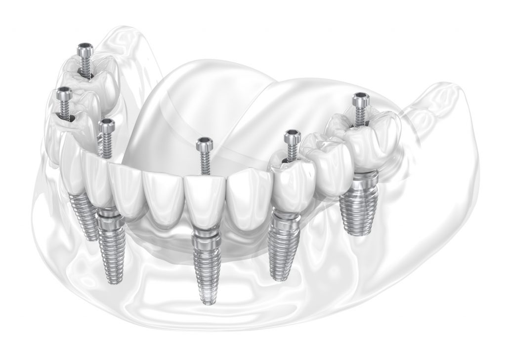 Teeth-in-a-day dental implants showing screws and dentures