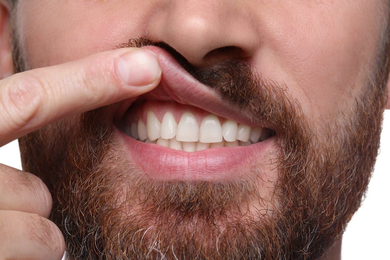 Man lifting his top lip to show his gums