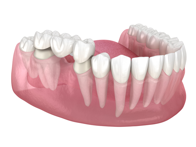 Dental bridge using modified natural teeth to anchor.