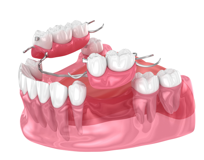 Removable partial dentures using wires to secure in place.