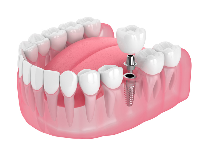 Single dental implant showing crown, abutment, and implant screw.